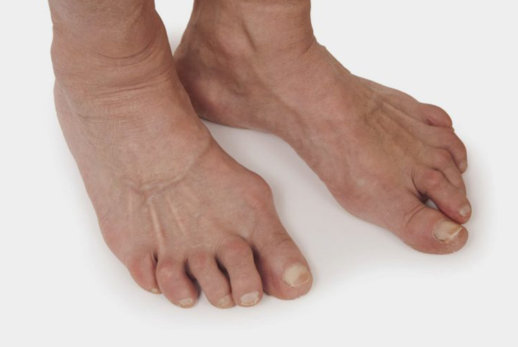 Nổi cục ở mu bàn chân do bệnh lý gì, cách điều trị ra sao? 2