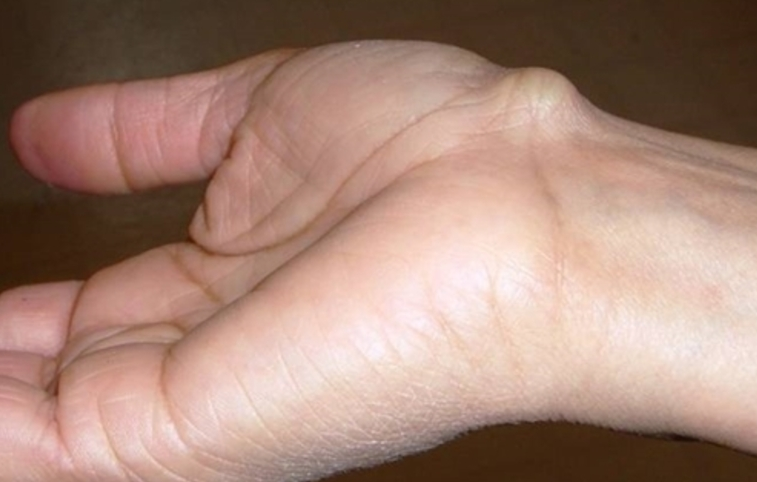 Nổi cục ở mu bàn tay là gì? Nguyên nhân và cách điều trị ra sao? 2