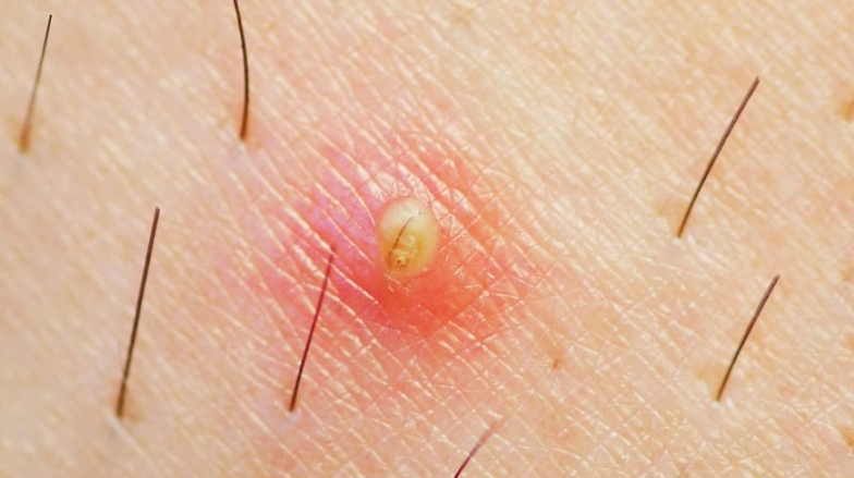 Nổi cục u ở mép vùng kín có nguy hiểm không? Cách chữa thế nào? 1