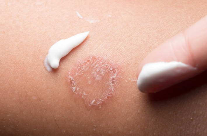 Nổi mẩn đỏ ngứa ở háng nữ giới là hiện tượng gì? 1