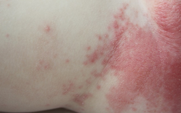 Nổi mẩn đỏ ngứa ở háng nữ giới là hiện tượng gì? 2