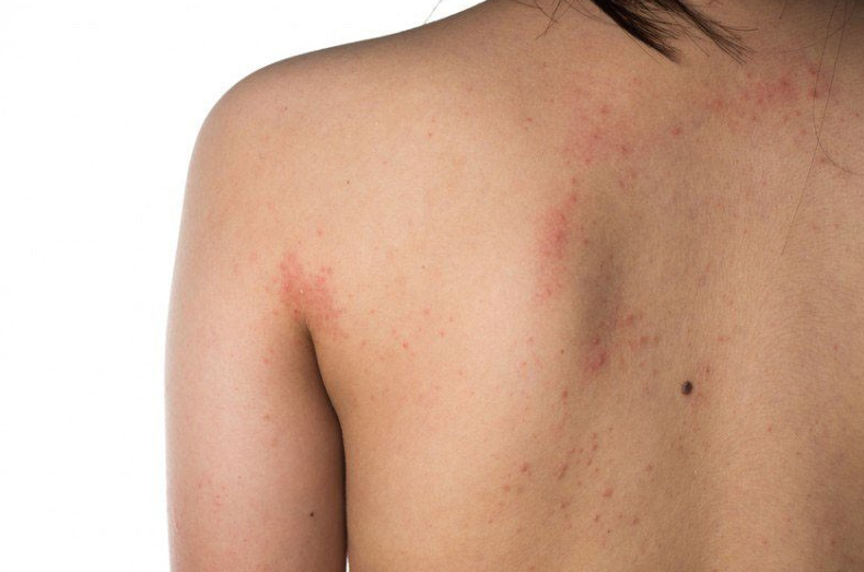 Nổi mẩn đỏ ở lưng không ngứa là do bệnh gì? 1