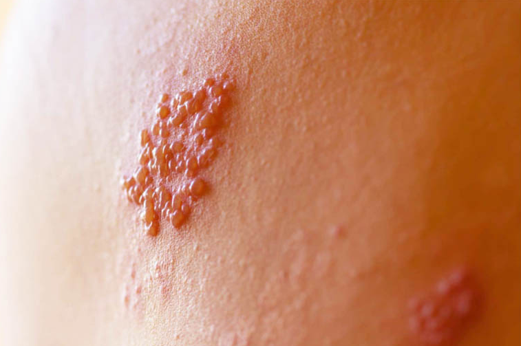 Nổi mẩn đỏ ở lưng không ngứa là do bệnh gì? 2