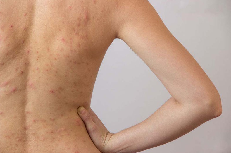 Nổi mẩn đỏ ở lưng không ngứa là do bệnh gì? 3