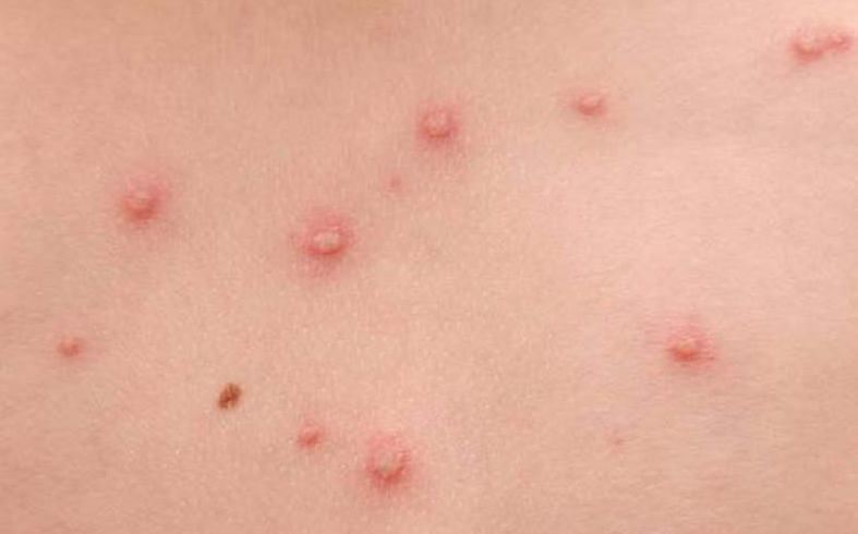 Nổi mẩn ngứa ở bắp chân là do những nguyên nhân nào? 1