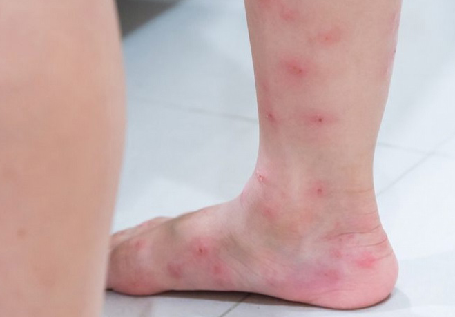 Nổi mẩn ngứa ở bắp chân là do những nguyên nhân nào? 1