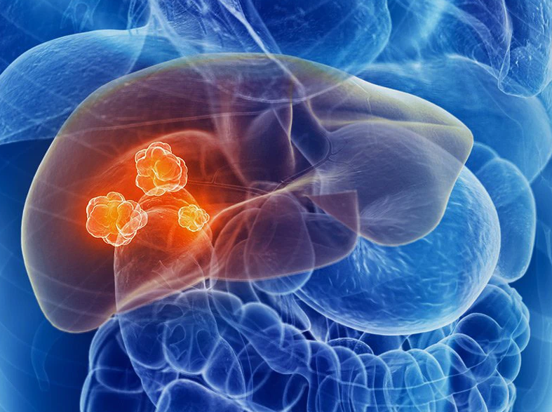 Nút mạch gan: Kỹ thuật điều trị ung thư gan hiệu quả 1