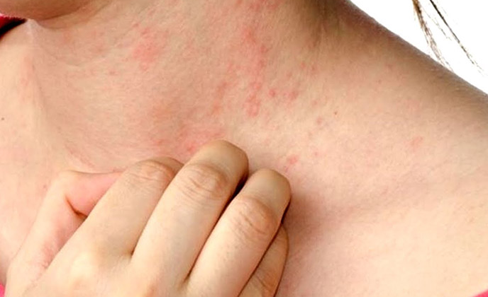 Phân biệt zona thần kinh và viêm da tiếp xúc 1