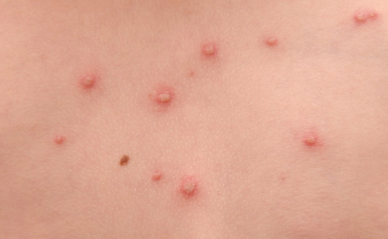 Phân biệt zona thần kinh và viêm da tiếp xúc 2