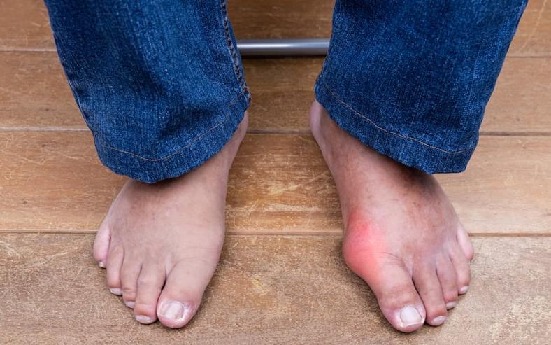 Phù tay chân do nguyên nhân gì? Khi nào cần đi khám bác sĩ? 1