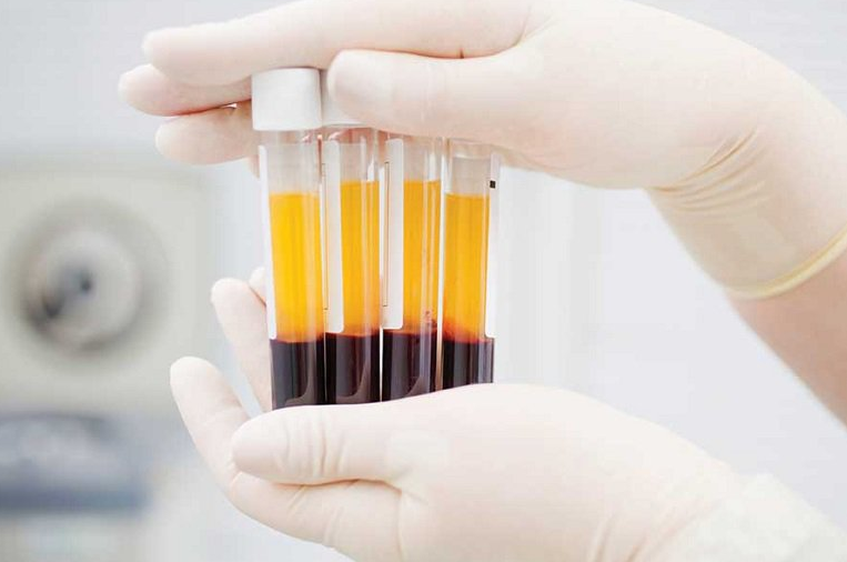 PRF: Phương pháp làm đẹp tự thân ứng dụng trong thẩm mỹ và nha khoa 3