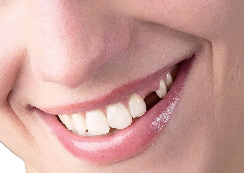 Răng nanh là gì? Có cần phải nhổ răng nanh không? 2