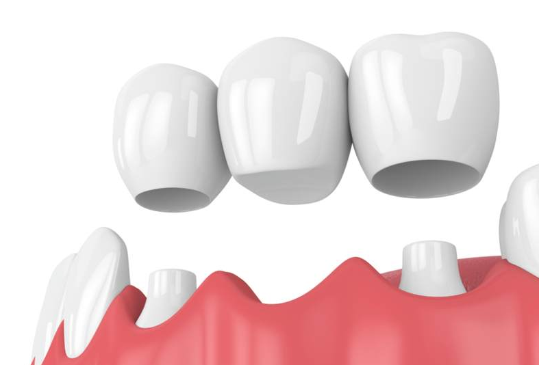 Răng nanh là gì? Có cần phải nhổ răng nanh không? 3