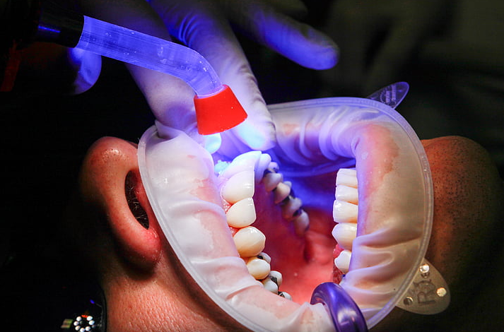 Răng sứ có đính đá được không? Những lưu ý quan trọng khi thực hiện đính đá 3