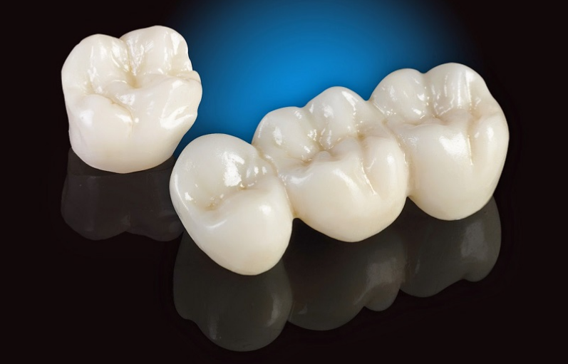 Răng sứ titan là gì? Ưu và nhược điểm của răng sứ titan 1