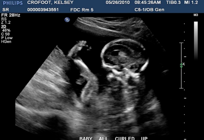 Siêu âm 2D có ảnh hưởng đến thai nhi không? 2