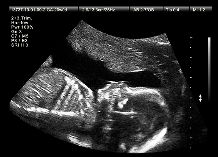 Siêu âm 2D và 4D cái nào chính xác hơn? Siêu âm 2D và 4D khác nhau thế nào? 1