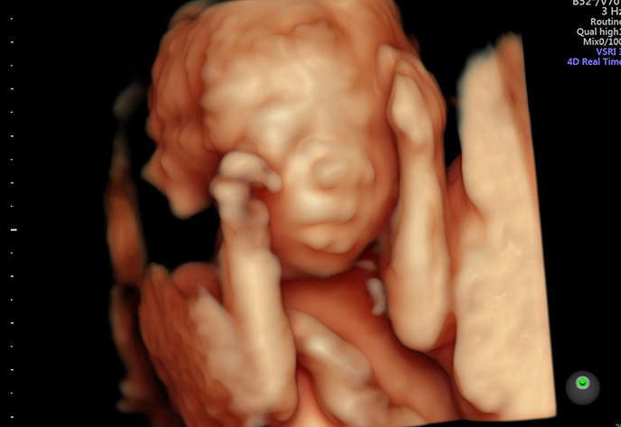 Siêu âm 5D khác gì 4D? Những câu hỏi thường gặp về siêu âm 5D 1