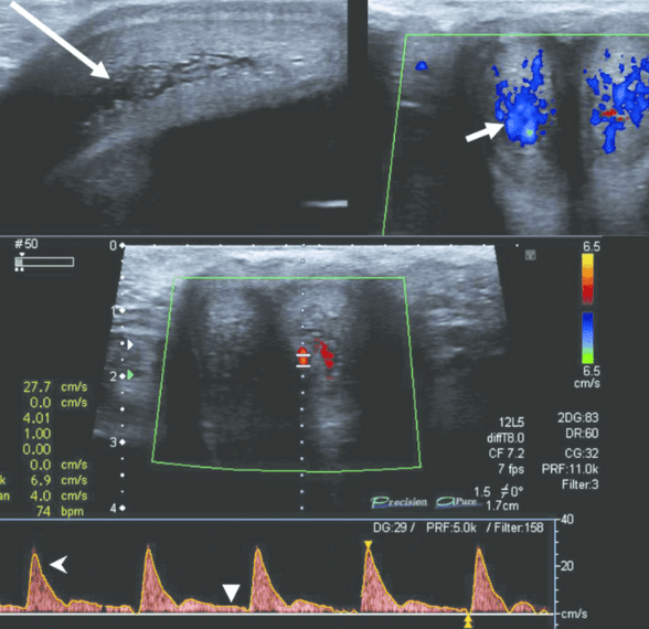 Siêu âm doppler dương vật là gì? Có thể phát hiện những bệnh lý gì? 3