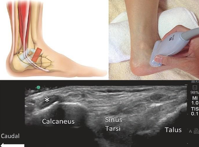 Siêu âm khớp cổ chân là gì? Được thực hiện khi nào và quy trình ra sao? 1