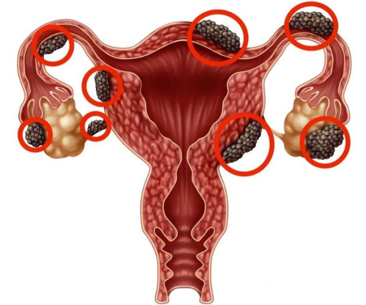 Siêu âm lạc nội mạc tử cung: Phương pháp chẩn đoán bệnh chính xác 1
