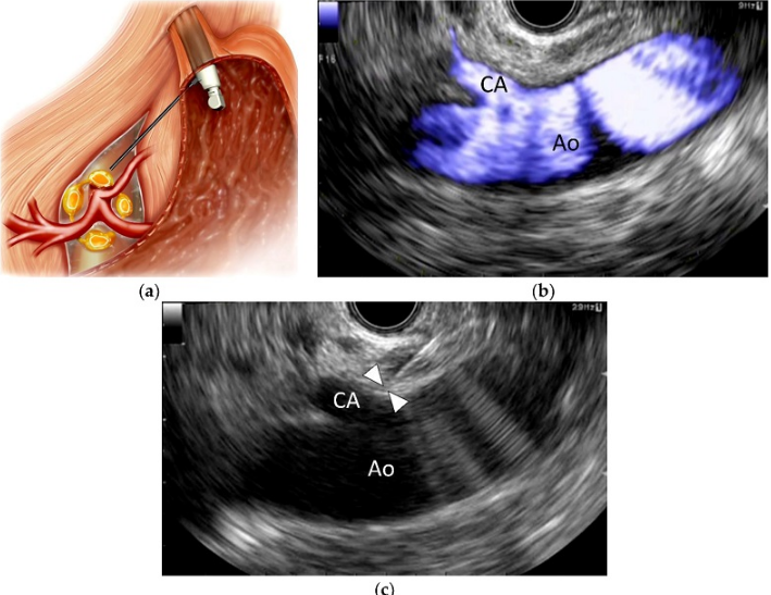 Siêu âm nội soi dạ dày là gì? Khi nào cần đến phương pháp này? 4