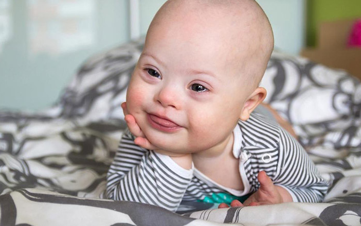 Siêu âm thai nhi mũi tẹt và mối liên hệ với hội chứng Down 1