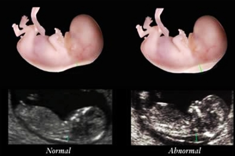 Siêu âm thai nhi mũi tẹt và mối liên hệ với hội chứng Down 2