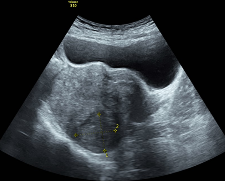 Siêu âm tử cung phần phụ là gì? Đối tượng nào cần siêu âm? 2