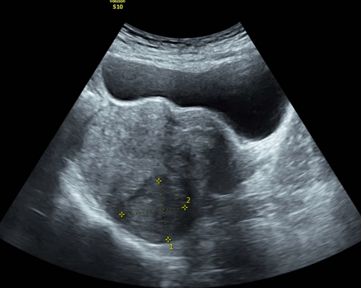 Siêu âm vùng chậu là gì? Phát hiện được những bệnh lý gì ở nam và nữ? 1