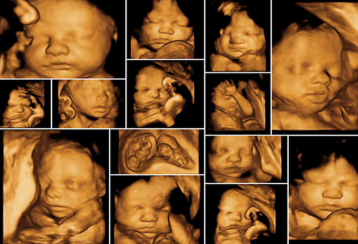 Sự khác nhau giữa siêu âm 2D 3D 4D 5D là như thế nào? 2