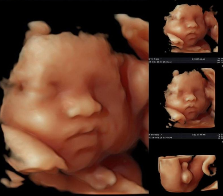 Sự khác nhau giữa siêu âm 2D 3D 4D 5D là như thế nào? 4