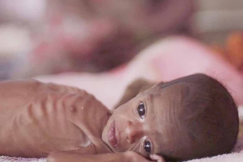 Suy dinh dưỡng thể marasmus là gì? 1