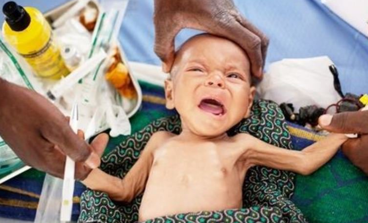 Suy dinh dưỡng thể marasmus là gì? 3