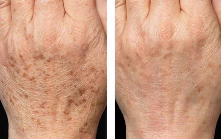 Tăng sắc tố da ở tay là do những nguyên nhân nào? Cách nhận biết? 1