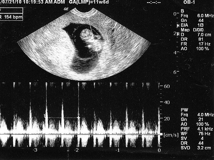 Thai mấy tuần thì siêu âm được? Các mốc thời gian siêu âm mẹ cần nhớ 4