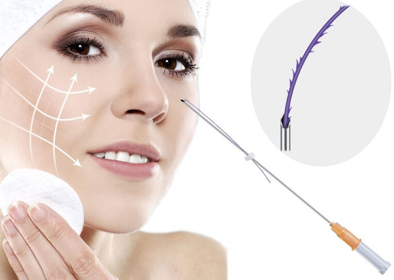 Thread lift: Phương pháp cấy chỉ thẩm mỹ để căng da mặt 3