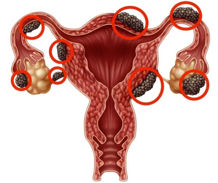 Thuốc đặc trị lạc nội mạc tử cung 1