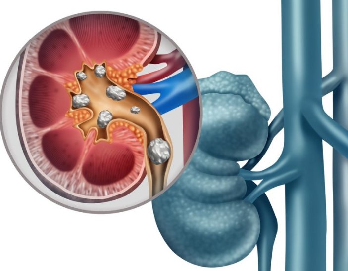Tiểu ra máu ở nam giới là gì, có nguy hiểm không? 2