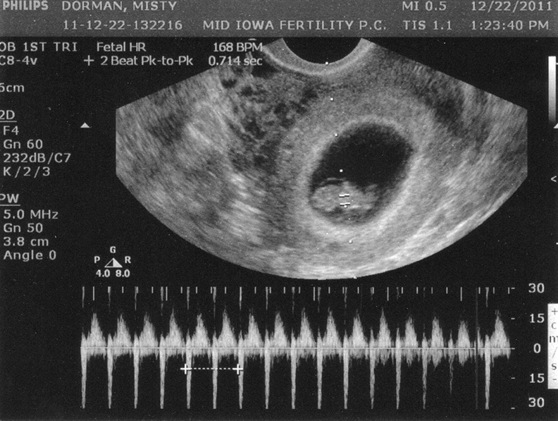 Tim thai tuần 7 bao nhiêu là bình thường? 4