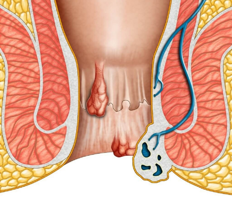 Trĩ hỗn hợp: Nguyên nhân, triệu chứng và cách điều trị 1