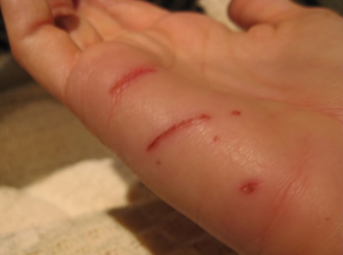 Trị mụn cóc bằng kem đánh răng, nên hay không? 2