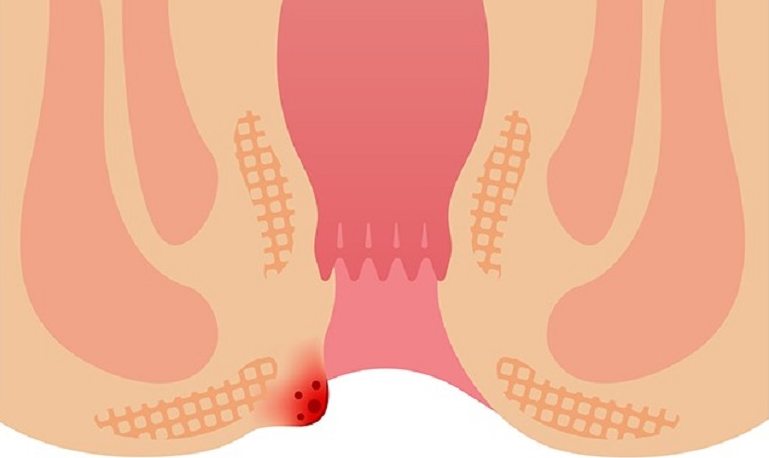 Trĩ ngoại độ 1 có nguy hiểm không? Chẩn đoán và điều trị trĩ ngoại độ 1 ra sao? 1