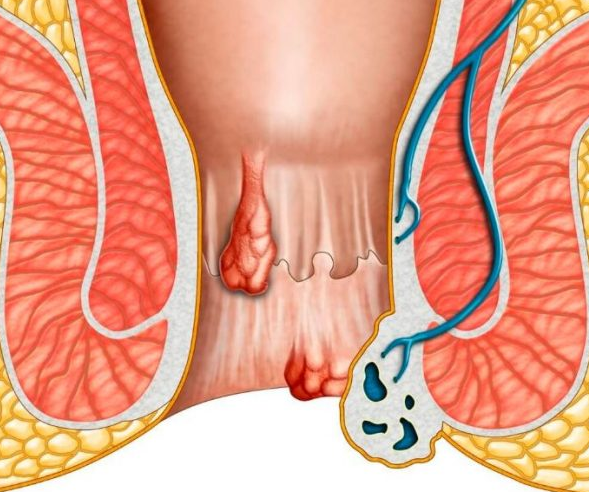 Trĩ ngoại tắc mạch là gì? Có nguy hiểm không và cách điều trị thế nào? 2
