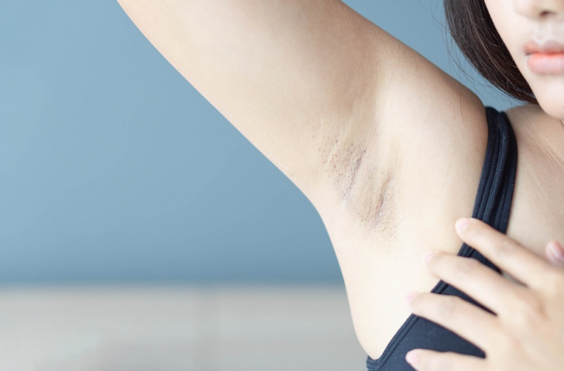Trị thâm nách bằng laser: Loại bỏ vùng da sẫm màu nhanh chóng 1