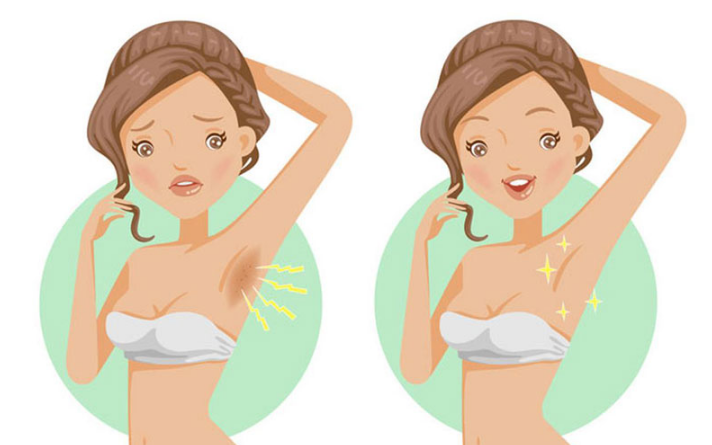 Trị thâm nách bằng laser: Loại bỏ vùng da sẫm màu nhanh chóng 2