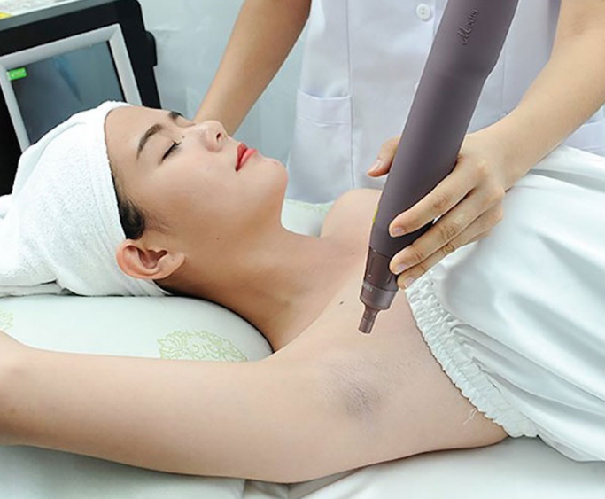 Trị thâm nách bằng laser: Loại bỏ vùng da sẫm màu nhanh chóng 4