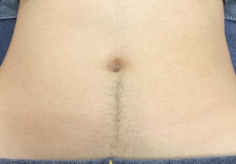 Triệt lông bụng có nên không? Có những phương pháp nào hiệu quả? 1