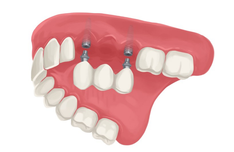 Trồng răng Implant có ăn được thịt gà không? Những lưu ý quan trọng khi ăn thịt gà sau cấy ghép 2