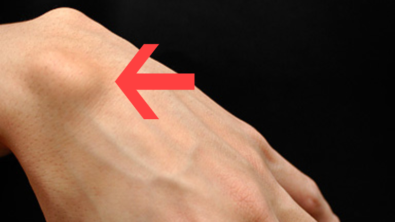 U nang hạch là gì? Nguyên nhân, triệu chứng và biện pháp điều trị hiệu quả 2